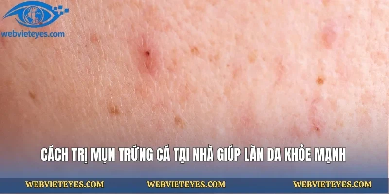 Cách Trị Mụn Trứng Cá Tại Nhà Giúp Làn Da Khỏe Mạnh